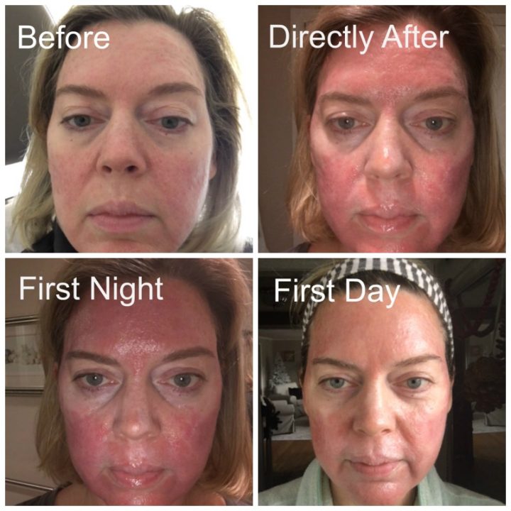 PDT Treatment and My Face, Before and After